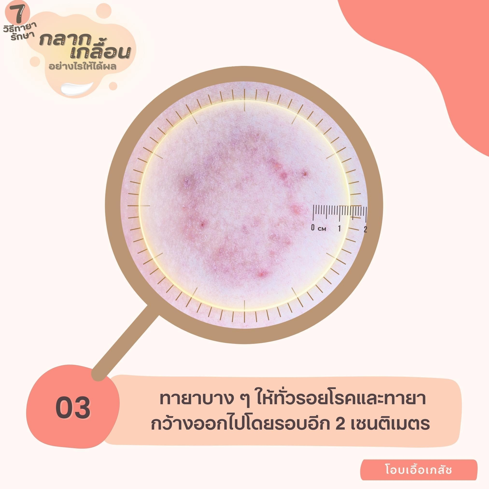 7 วิธีทายากลากเกลื้อนอย่างไรให้ได้ผล-4